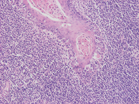 histología de las amígdalas faríngeas