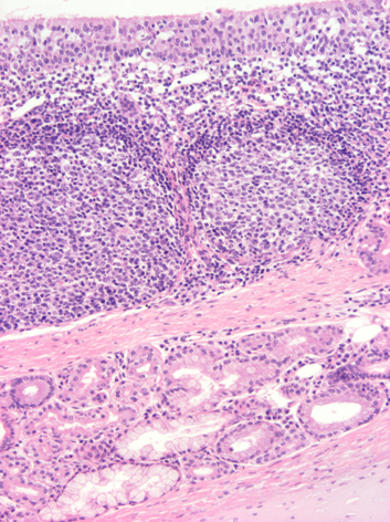 histología de las amígdalas faríngeas