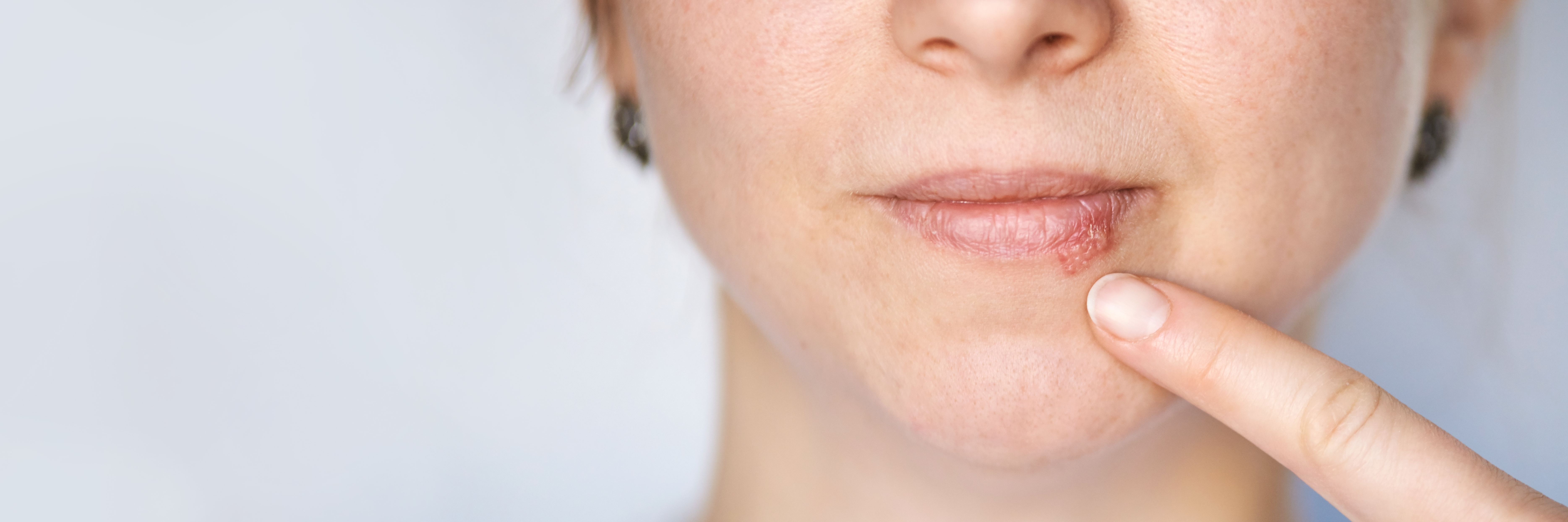Proteger los labios del sol: una barrera frente al herpes labial